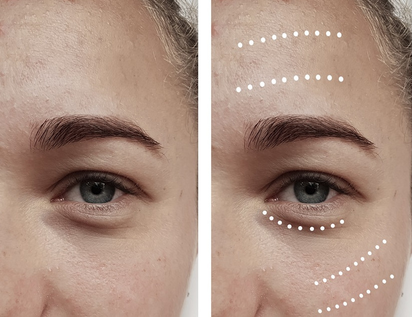 Oculoplastic Surgery